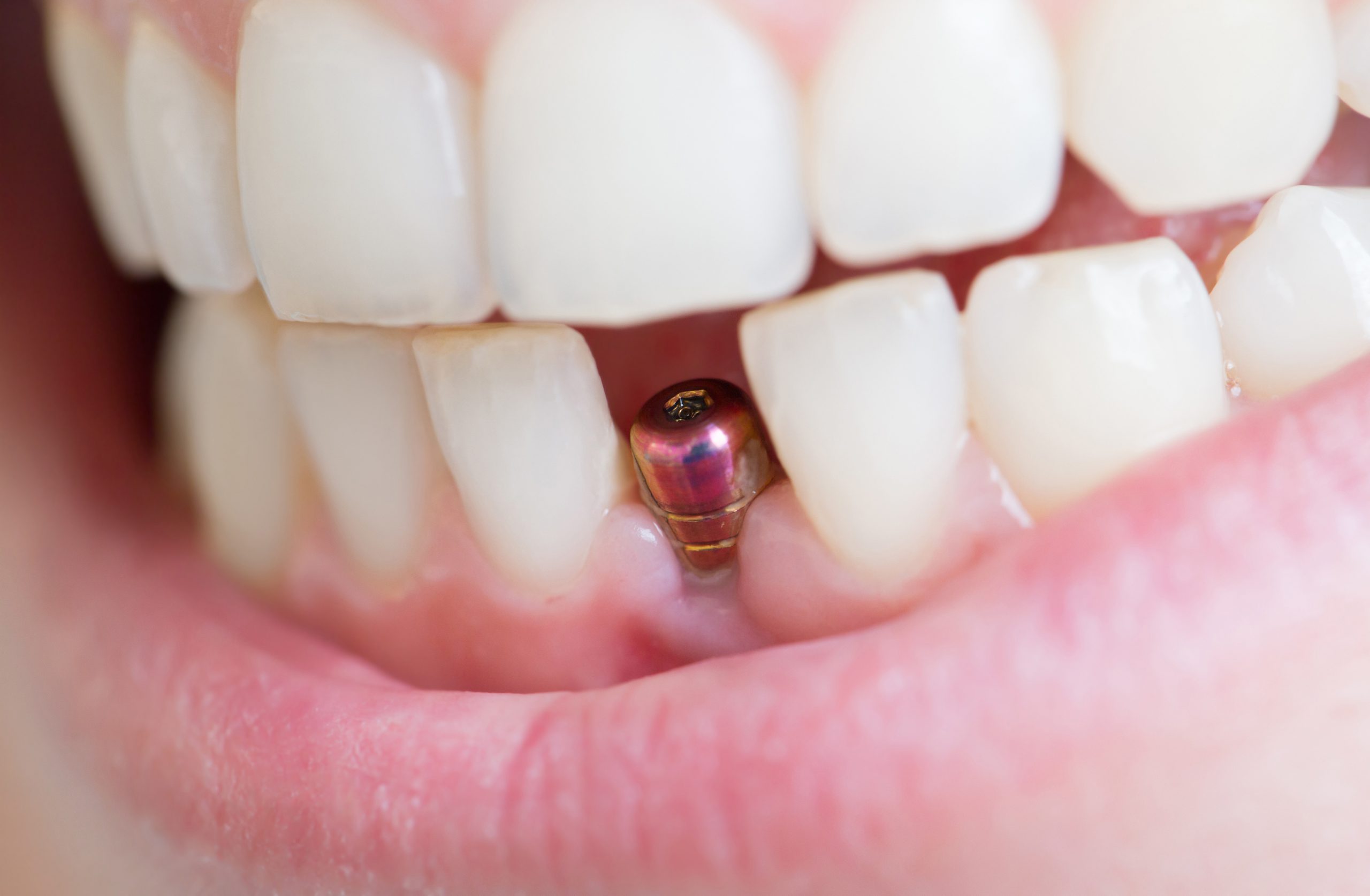 Implantat Sofortimplantation