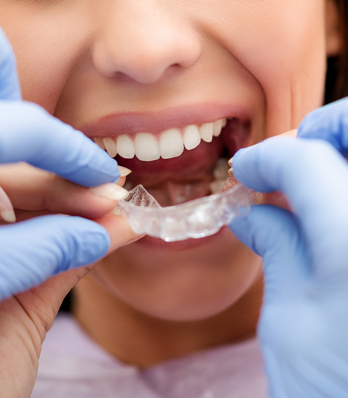 Aligner Therapie transparente Zahnschiene in der Erlenbusch Praxis Münster